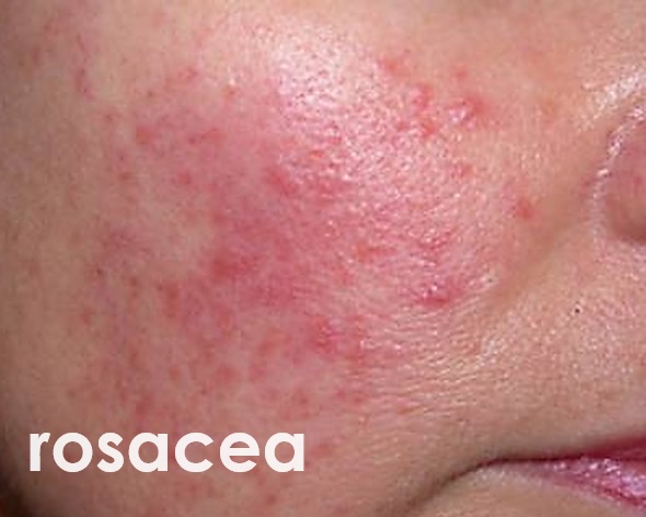 Rode wangen door rosacea