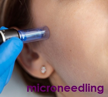 Microneedling